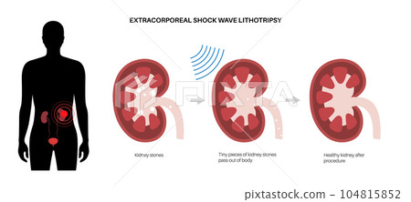 Lithotripsy procedure concept 104815852