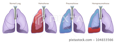 肺、氣管、氣胸、血胸、血氣胸的插圖 肺、氣管、氣胸、血胸、血氣胸的插圖 104833566