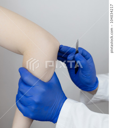 Elbow surgery. Surgeon shows the patient where the incision will be with scalpel for operation due to tendon rupture, cartilage damage, bone prick. Concept of restoring joint mobility and arthroplasty Elbow surgery. Surgeon shows the patient where the incision will be with scalpel for operation due to tendon rupture, cartilage damage, bone prick. Concept of restoring joint mobility and arthroplasty 104834217