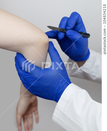 Elbow surgery. Surgeon shows the patient where the incision will be with scalpel for operation due to tendon rupture, cartilage damage, bone prick. Concept of restoring joint mobility and arthroplasty 104834218