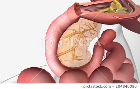 Gastric sleeve surgery is a surgical procedure in which most of the stomach is removed for weight loss Gastric sleeve surgery is a surgical procedure in which most of the stomach is removed for weight loss 104840086