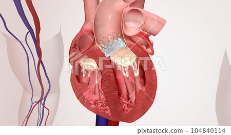Valve insertion into damaged heart valve 104840114
