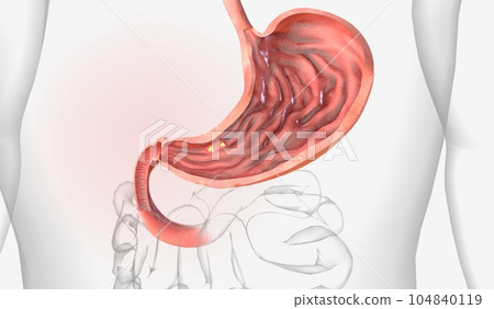 Stomach ulcers (gastric ulcers) are open sores that develop on the lining of the stomach 104840119