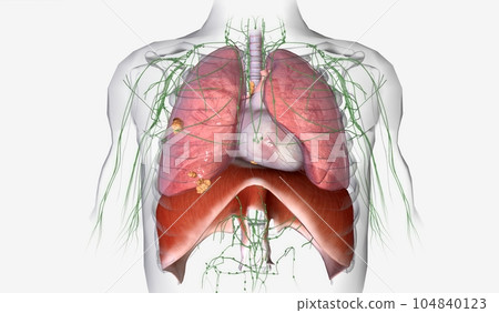 The Lung Cancer Stage III The Lung Cancer Stage III 104840123
