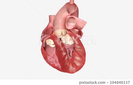 Removes excess heart muscle tissue, improves blood flow 104840137