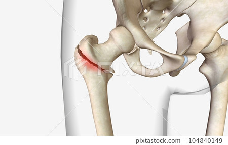 A pertrochanteric fracture is a hip fracture that is found in the trochanteric region of the femur 104840149