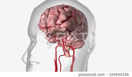 A transient ischemic attack is a mini stroke with similar symptoms to an ischemic stroke but without lasting effects. 104840186