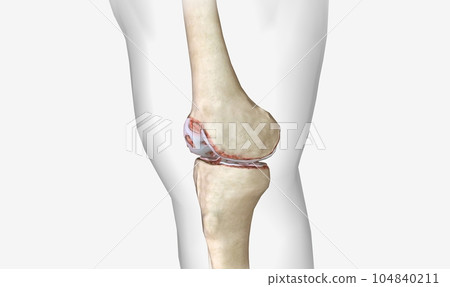Osteoarthritis is a degenerative form of arthritis that affects articular cartilage Osteoarthritis is a degenerative form of arthritis that affects articular cartilage 104840211