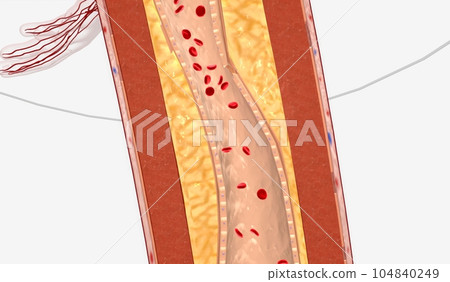 Narrowed Blood Vessel in Lower Extremity 104840249