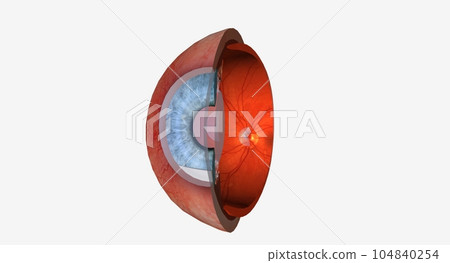 Uveitis is swelling and irritation of the uvea, the middle layer Uveitis is swelling and irritation of the uvea, the middle layer 104840254