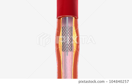 The balloon expends, widening the wire mesh stent and the artery The balloon expends, widening the wire mesh stent and the artery 104840257
