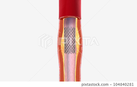 The balloon expends, widening the wire mesh stent and the artery 104840281