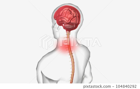 Meningitis is the inflammation of the meninges Meningitis is the inflammation of the meninges 104840292