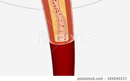 Narrowed Blood Vessel in Lower Extremity Narrowed Blood Vessel in Lower Extremity 104840315