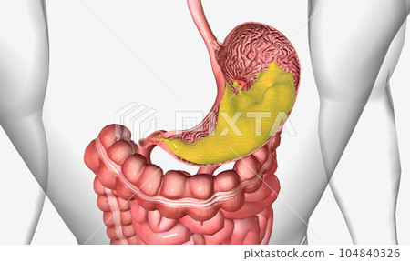 Peptic ulcer disease, is the formation of ulcers in the lining of the stomach and first section of the small intestine Peptic ulcer disease, is the formation of ulcers in the lining of the stomach and first section of the small intestine 104840326