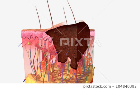 Stage I melanoma tumors have spread out of the epidermis and into the dermis Stage I melanoma tumors have spread out of the epidermis and into the dermis 104840392