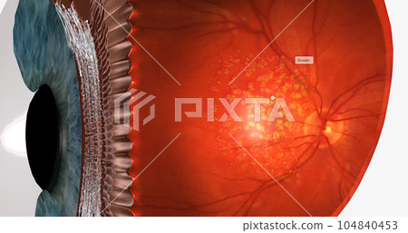 Dry macular degeneration is a type of age-related vision impairment that results in blurred or lost central vision. Dry macular degeneration is a type of age-related vision impairment that results in blurred or lost central vision. 104840453