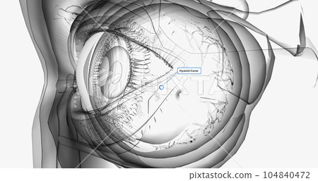 Hyaloid Canal, It is filled with lymph and lined by a prolongation of the hyaloid membrane. Hyaloid Canal, It is filled with lymph and lined by a prolongation of the hyaloid membrane. 104840472