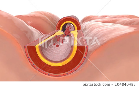 Fat deposits within the artery can build up at the injury site a Fat deposits within the artery can build up at the injury site a 104840485