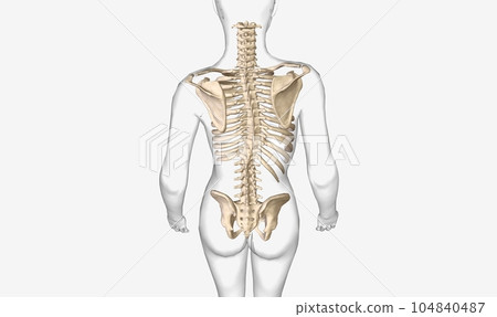 Scoliosis is a lateral (sideways) curvature of the spine 104840487