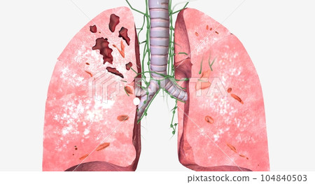 The Tuberculosis EarlyIntermediate in Lungs 104840503