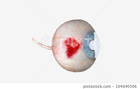 Subconjunctival hemorrhage is a bright red patch appearing in the white of the eye 104840506