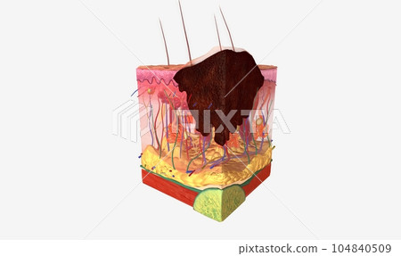 The Stage II melanoma tumors The Stage II melanoma tumors 104840509