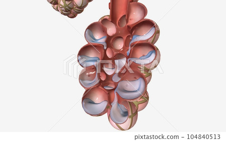 Pulmonary edema is a condition caused by too much fluid in the lungs. 104840513