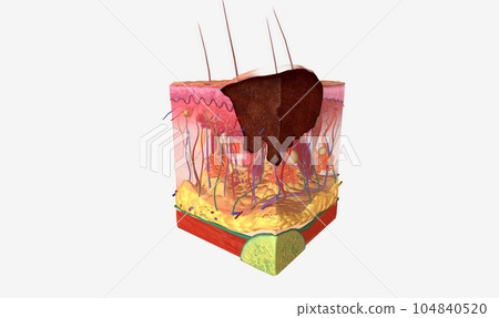 Stage I melanoma tumors have spread out of the epidermis and into the dermis 104840520