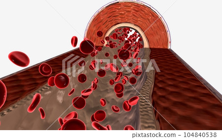 Pulmonary hypertension happens when the pressure in the blood vessels leading from the heart to the lungs is too high. 104840538