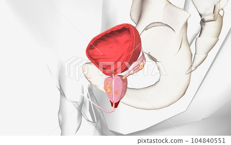 The Stage III Prostate Cancer The Stage III Prostate Cancer 104840551