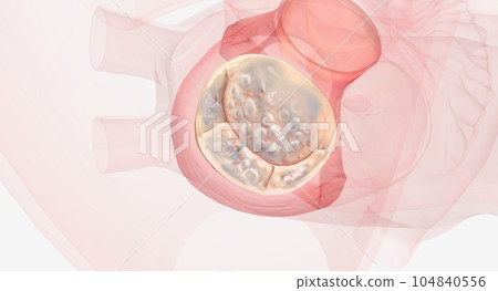 Traditional Surgical Mitral Valve Repair Traditional Surgical Mitral Valve Repair 104840556
