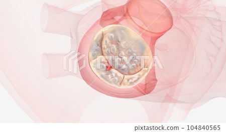 Traditional Surgical Mitral Valve Repair Traditional Surgical Mitral Valve Repair 104840565