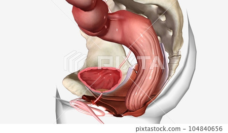 The Urinary tract infections (UTIs) 104840656
