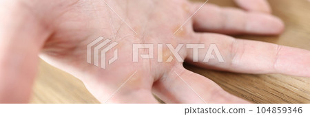 Calluses at distal palmar surface of hands. 104859346