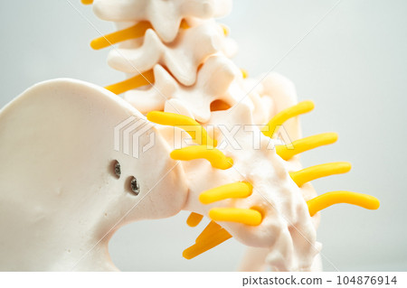 Lumbar spine displaced herniated disc fragment, spinal nerve and bone. Model for treatment medical in the orthopedic department. Lumbar spine displaced herniated disc fragment, spinal nerve and bone. Model for treatment medical in the orthopedic department. 104876914