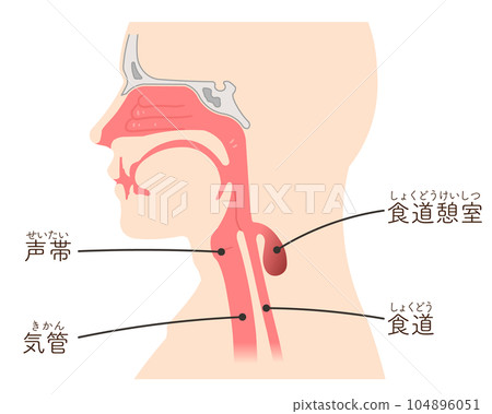 Illustration of esophageal diverticulum, Zenker's diverticulum, zenker's diverticulum, diverticular perforation, diverticulum Illustration of esophageal diverticulum, Zenker's diverticulum, zenker's diverticulum, diverticular perforation, diverticulum 104896051