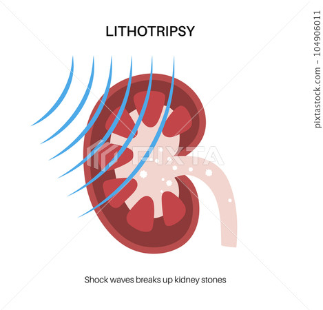 Lithotripsy procedure concept 104906011