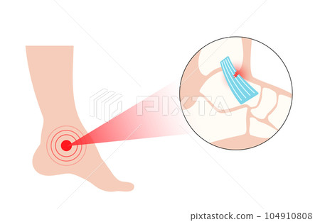 Sprained ankle injury Sprained ankle injury 104910808