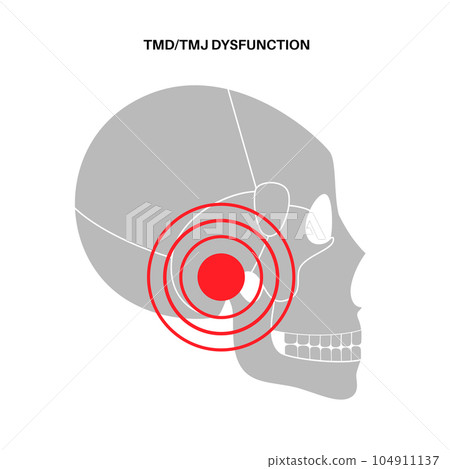 TMD TMJ disorder 104911137