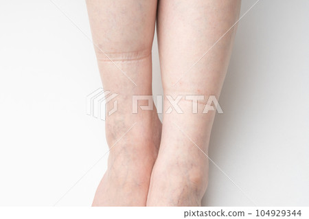 腳腫了 橡膠痕跡 104929344