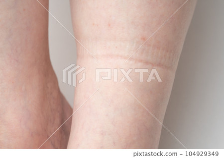 Swollen feet Rubber marks 104929349