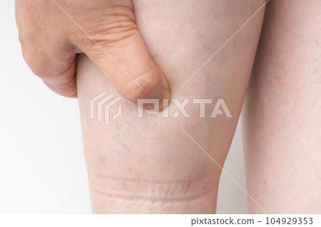 Swollen feet Rubber marks 104929353