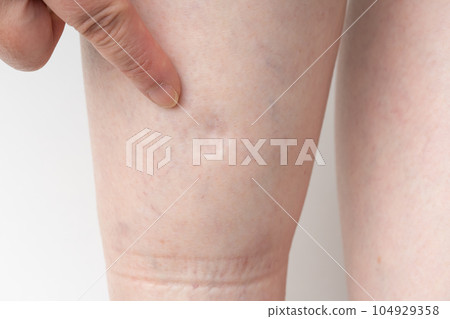 Swollen feet Rubber marks 104929358