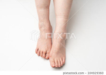 腳腫了 橡膠痕跡 腳腫了 橡膠痕跡 104929360