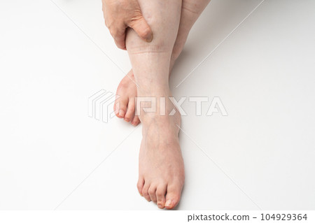 腳腫了 橡膠痕跡 104929364