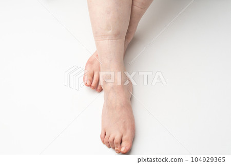 腳腫了 橡膠痕跡 腳腫了 橡膠痕跡 104929365