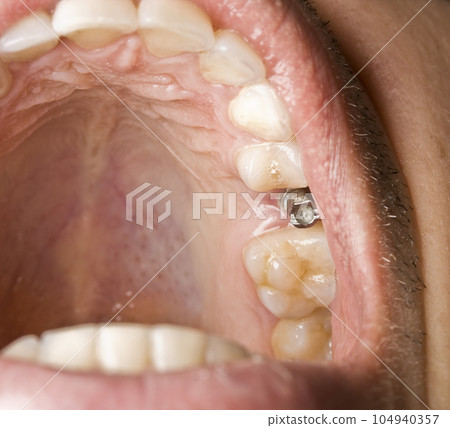 Dentistry implant Dentistry implant 104940357