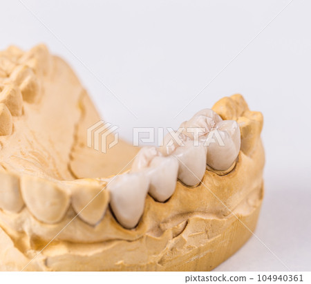 Dental prosthesis 104940361