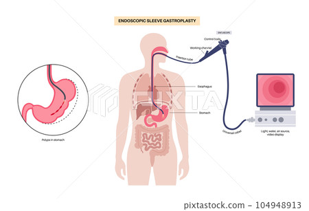 Endoscopic sleeve gastroplasty 104948913
